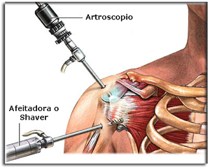 cirugía artroscópica de hombro