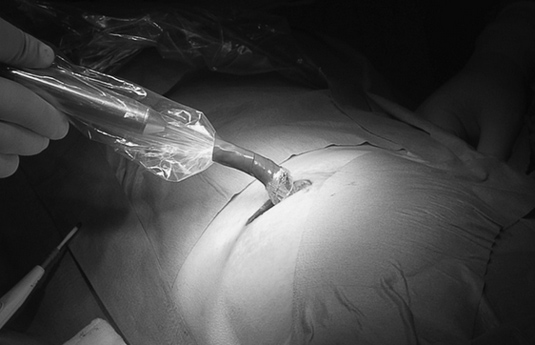 Cirugía mamaria radioguiada