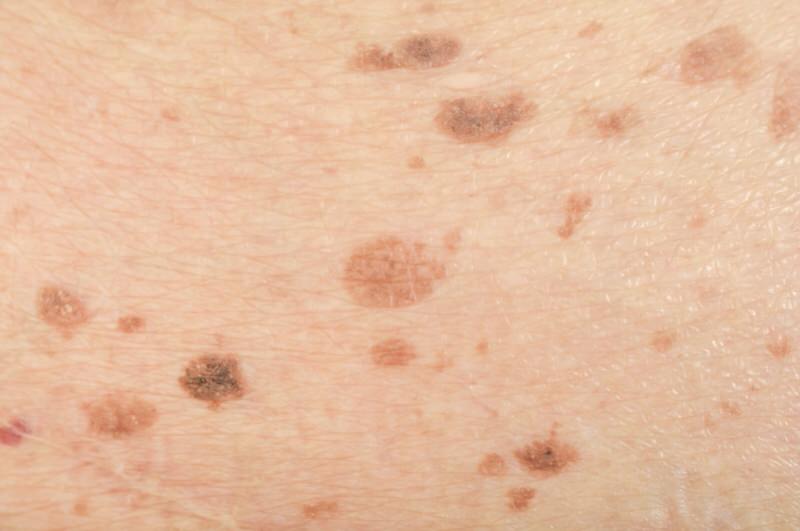 Cáncer de piel el más frecuente para los cubanos Cáncer de piel el más frecuente para los cubanos